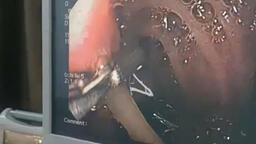 BỆNH VIỆN ĐA KHOA TỈNH  LAI CHÂU THỰC HIỆN CẤP CỨU GẮP  GIUN CHUI ỐNG MẬT CHO TRẺ 6 TUỔI BẰNG (ERCP)