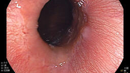 Bệnh viện Đa khoa tỉnh Nội soi gắp thành công dị vật Hành tá tràng ở trẻ em