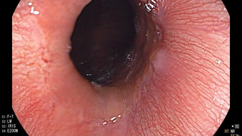 Bệnh viện Đa khoa tỉnh Nội soi gắp thành công dị vật Hành tá tràng ở trẻ em