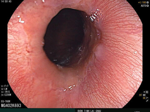 Bệnh viện Đa khoa tỉnh Nội soi gắp thành công dị vật Hành tá tràng ở trẻ em