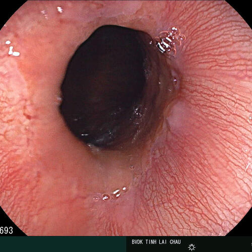 Bệnh viện Đa khoa tỉnh Nội soi gắp thành công dị vật Hành tá tràng ở trẻ em