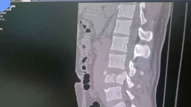 BỆNH VIỆN ĐA KHOA TỈNH LAI CHÂU PHẪU THUẬT THÀNH CÔNG CA BỆNH NHÂN CHẤN THƯƠNG CỘT SỐNG THẮT LƯNG CÓ TỔN THƯƠNG TỦY SỐNG