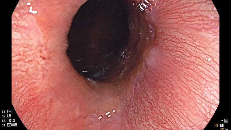 Bệnh viện Đa khoa tỉnh Nội soi gắp thành công dị vật Hành tá tràng ở trẻ em